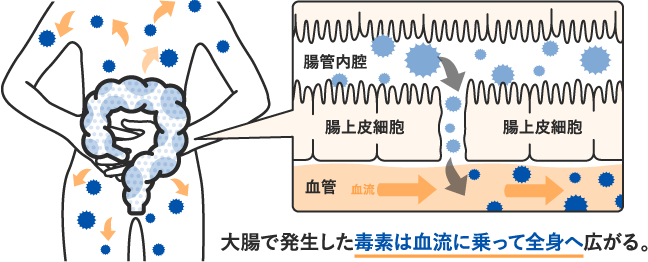 腸もれ